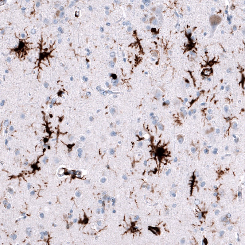 Staining of human cerebral cortex (Alzheimer disease) shows strong cytoplasmic positivity in microglia.
