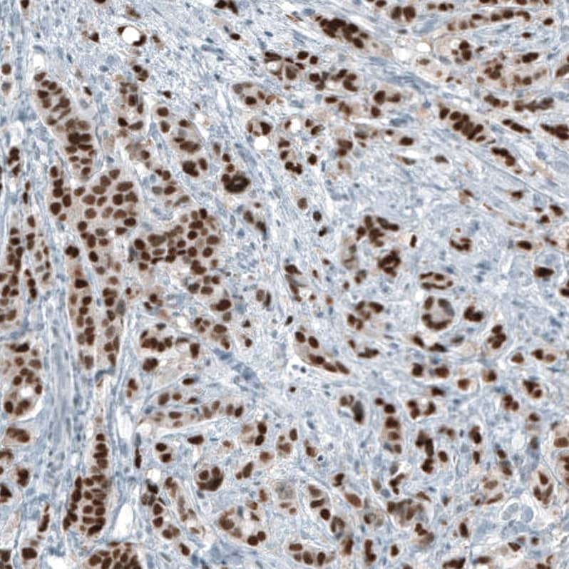 Staining of human breast cancer shows strong nuclear positivity in tumor cells.