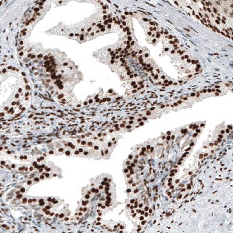 Staining of human prostate cancer shows strong nuclear positivity in tumor cells.