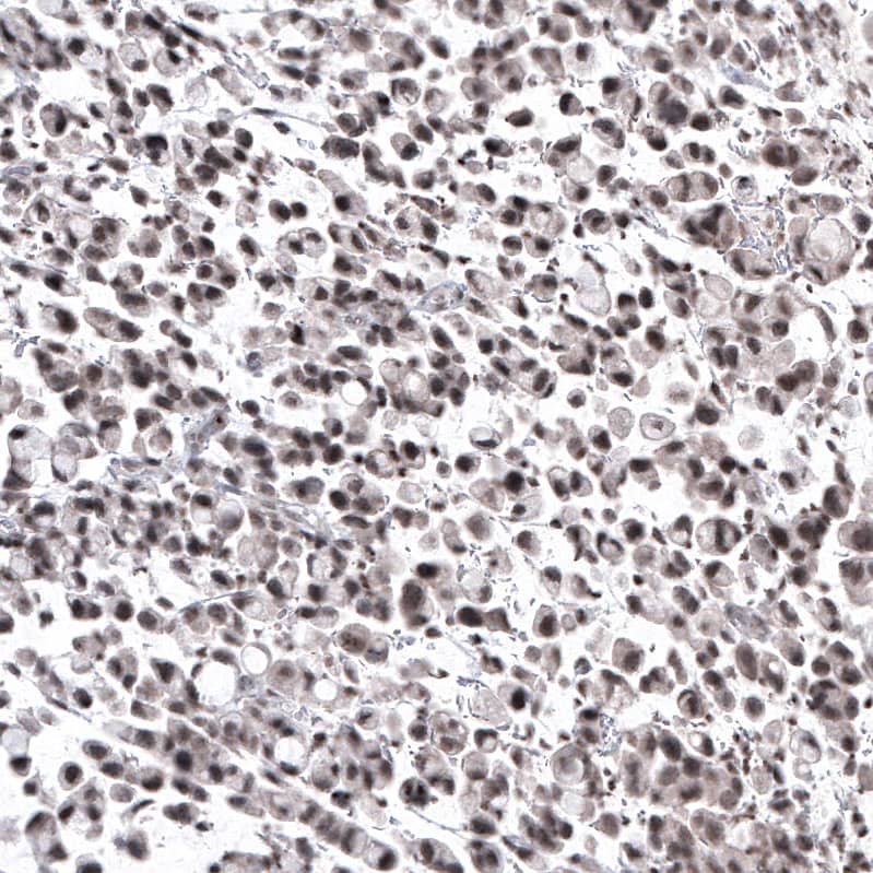 Staining of human stomach cancer shows moderate nuclear positivity.
