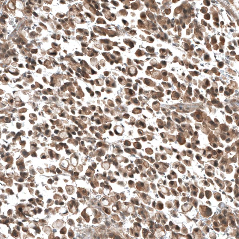 Staining of human stomach cancer shows moderate cytoplasmic positivity in tumor cells.