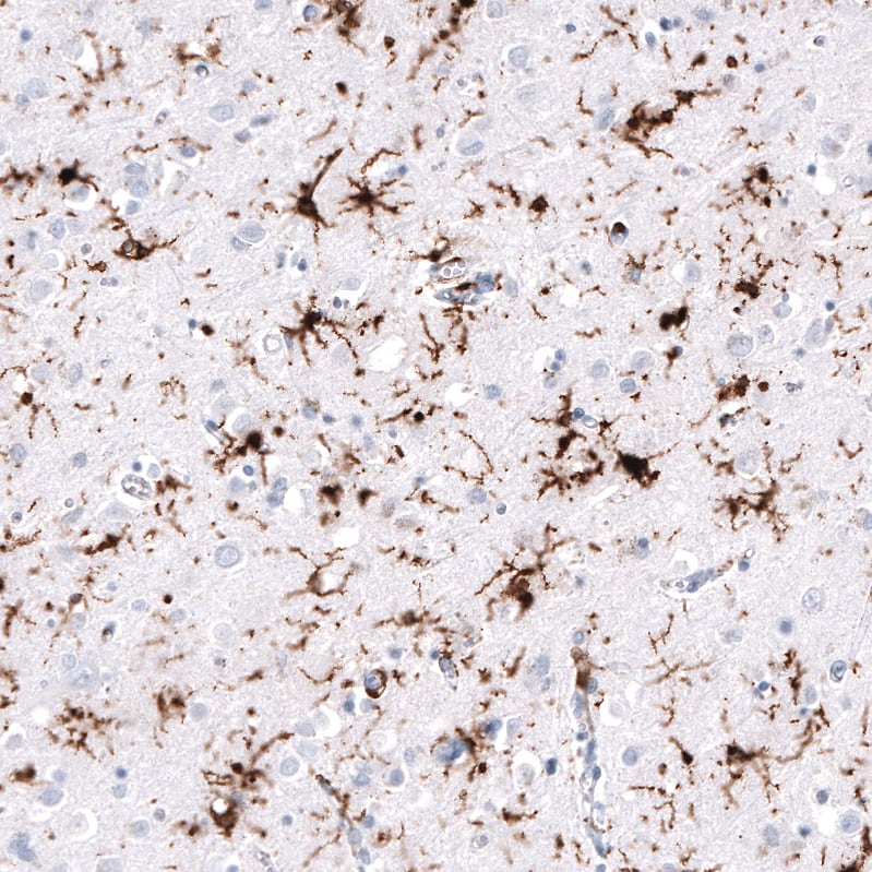 Staining of human cerebral cortex (Alzheimer disease) shows strong cytoplasmic positivity in microglia.