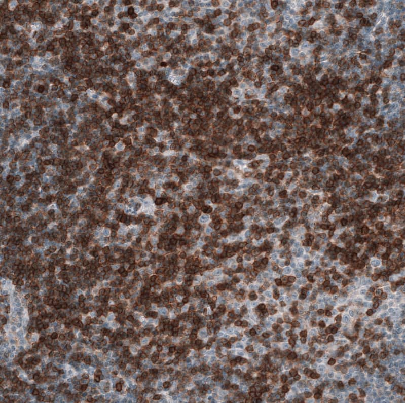 Staining of human chronic lymphocytic leukemia shows strong membranous positivity in tumor cells.