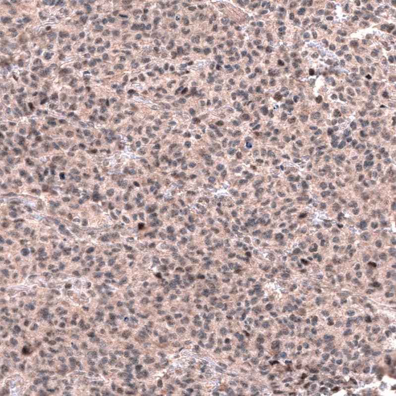 Staining of human oligodendroglioma shows moderate nuclear positivity in a subset of tumor cells.