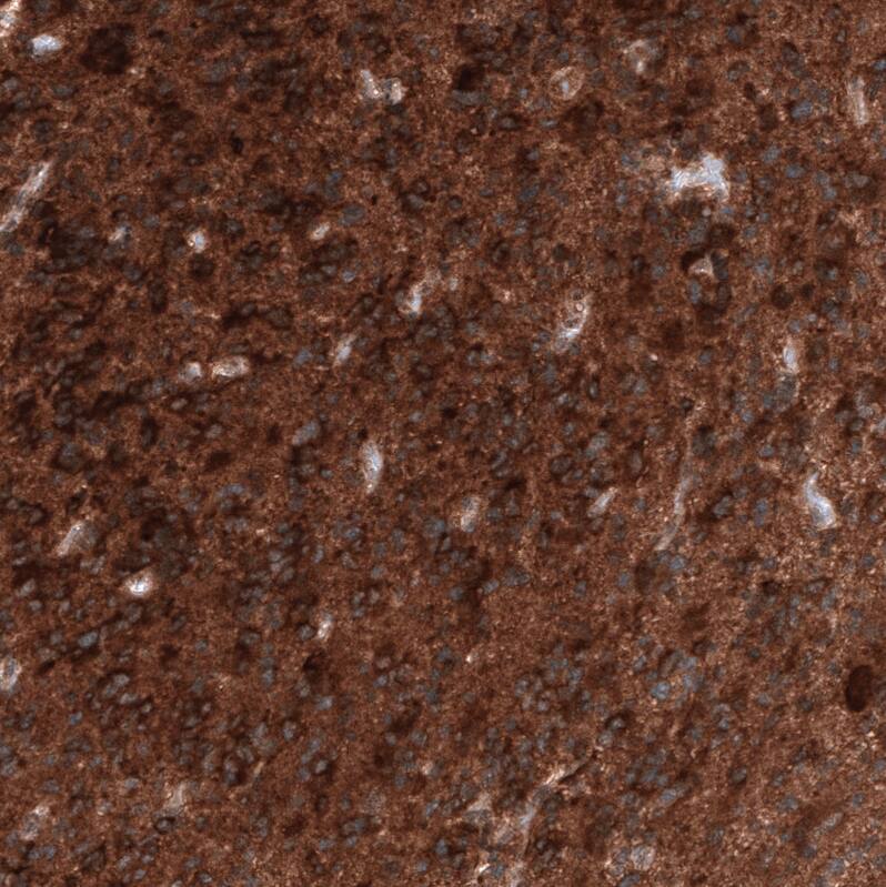 Staining of human glioblastoma multiforme shows strong positivity in tumor cells.