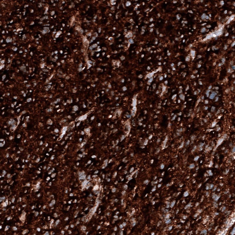 Staining of human glioblastoma multiforme shows strong positivity in tumor cells.