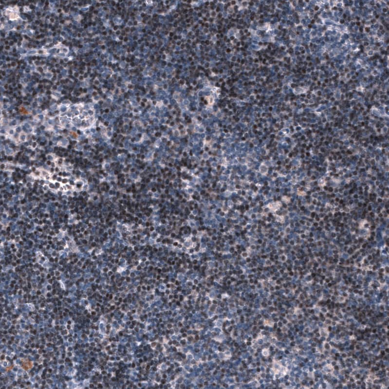 Staining of human chronic lymphocytic leukemia shows moderate nuclear positivity in tumor cells.