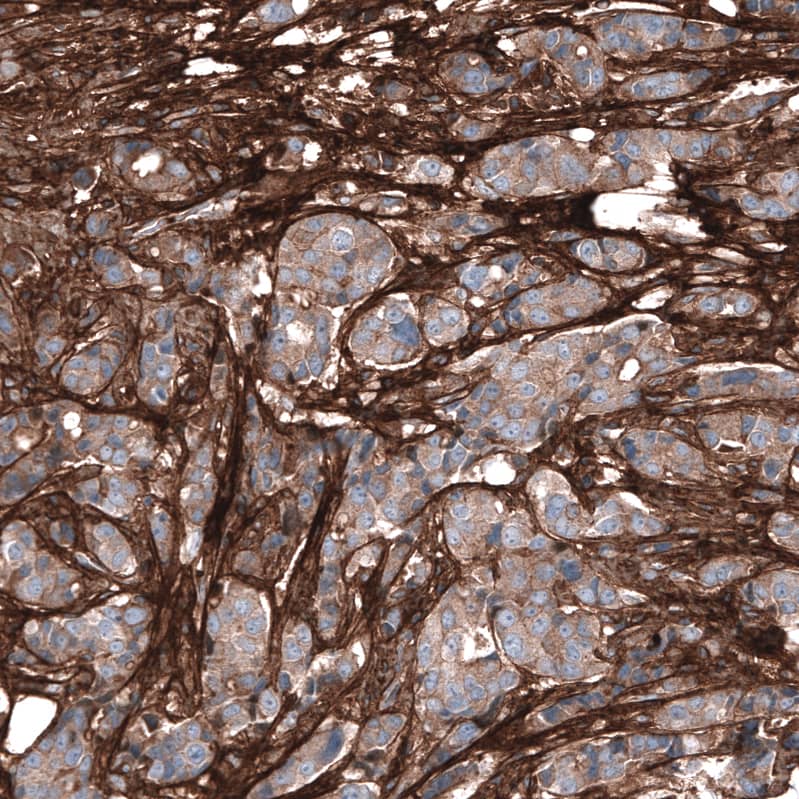 Staining of human breast cancer shows strong positivity in extracellular matrix.