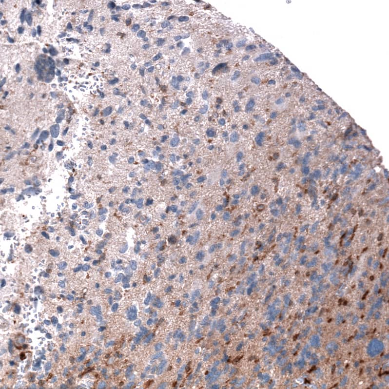 Staining of human glioblastoma shows moderate to strong positivity.