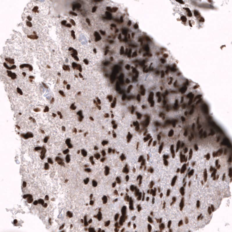 Staining of human glioblastoma multiforme shows strong nuclear positivity in tumor cells.