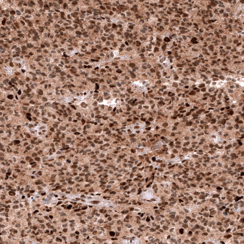 Staining of human oligodendroglioma shows strong nuclear positivity in tumor cells.