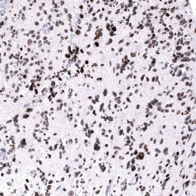 Staining of human glioblastoma multiforme shows strong nuclear positivity in tumor cells.