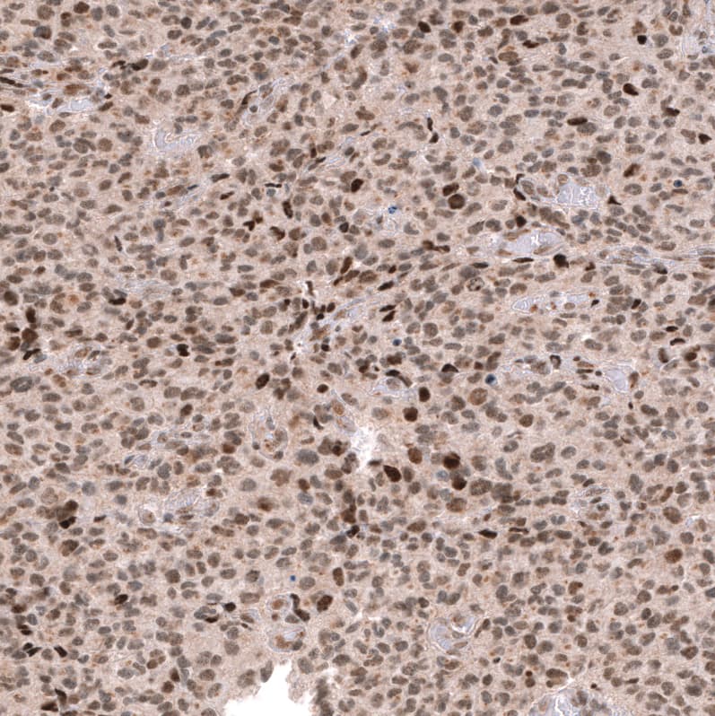 Staining of human oligodendroglioma shows moderate to strong nuclear positivity in tumor cells.