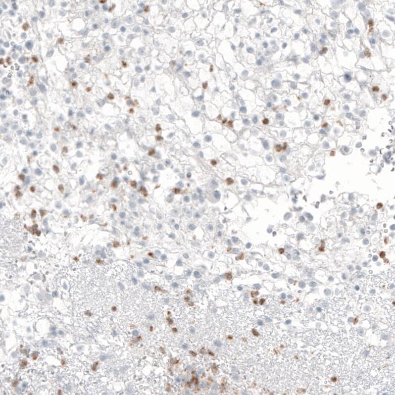 Staining of human renal cancer shows moderate cytoplasmic positivity in lymphoid cells.
