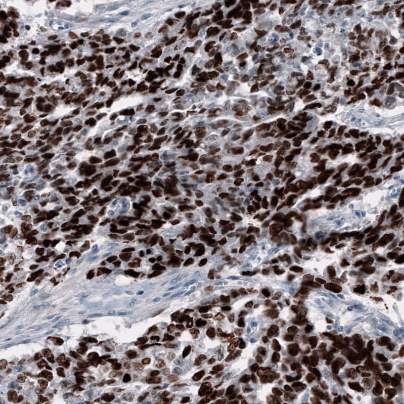 Staining of human testis cancer (embryonal carcinoma) shows strong nuclear positivity in tumor cells.