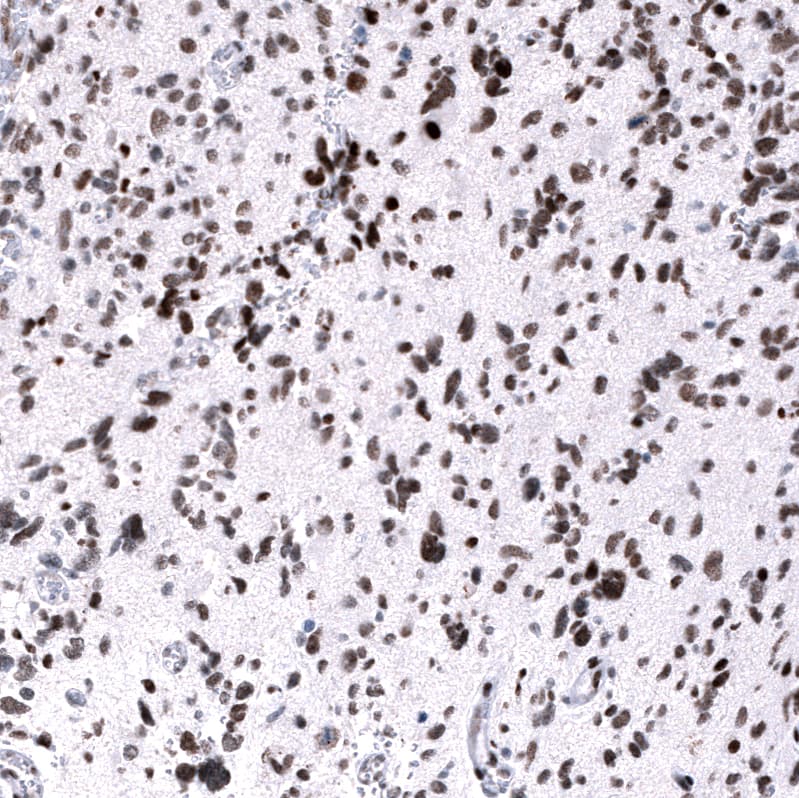 Staining of human glioblastoma multiforme shows strong nuclear positivity in tumor cells.