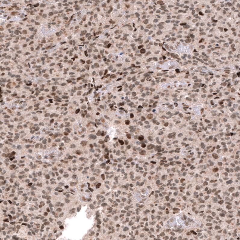 Staining of human oligodendroglioma shows moderate to strong nuclear positivity in tumor cells.