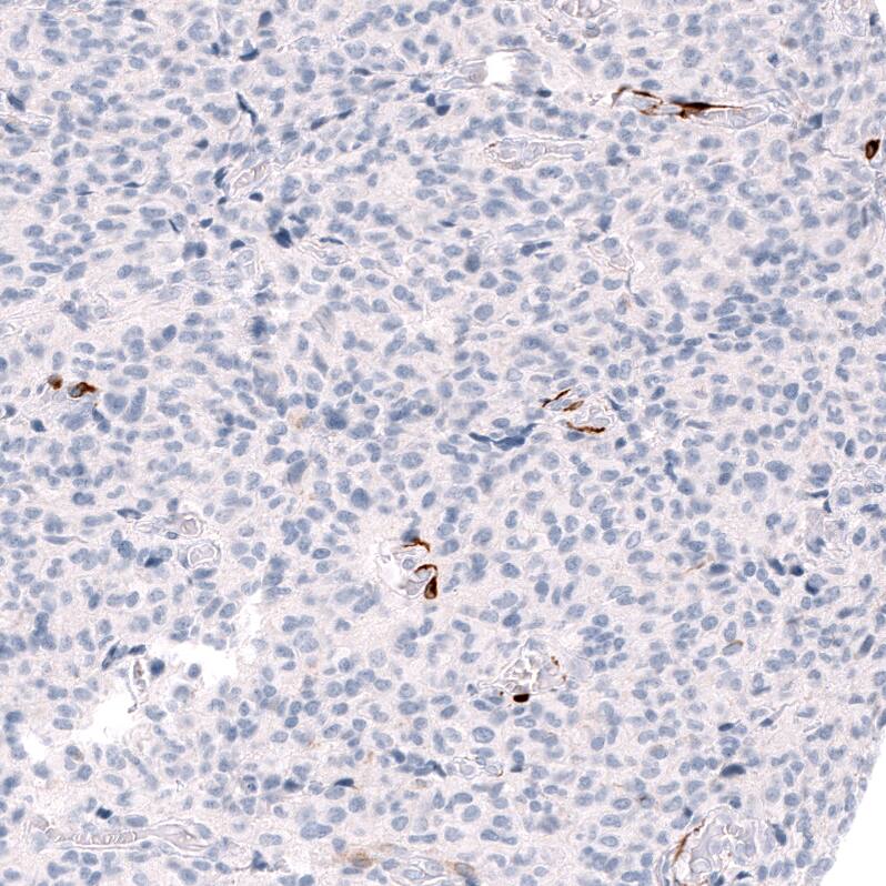 Staining of human anaplastic oligodendroglioma shows strong cytoplasmic positivity in a subset of cells.