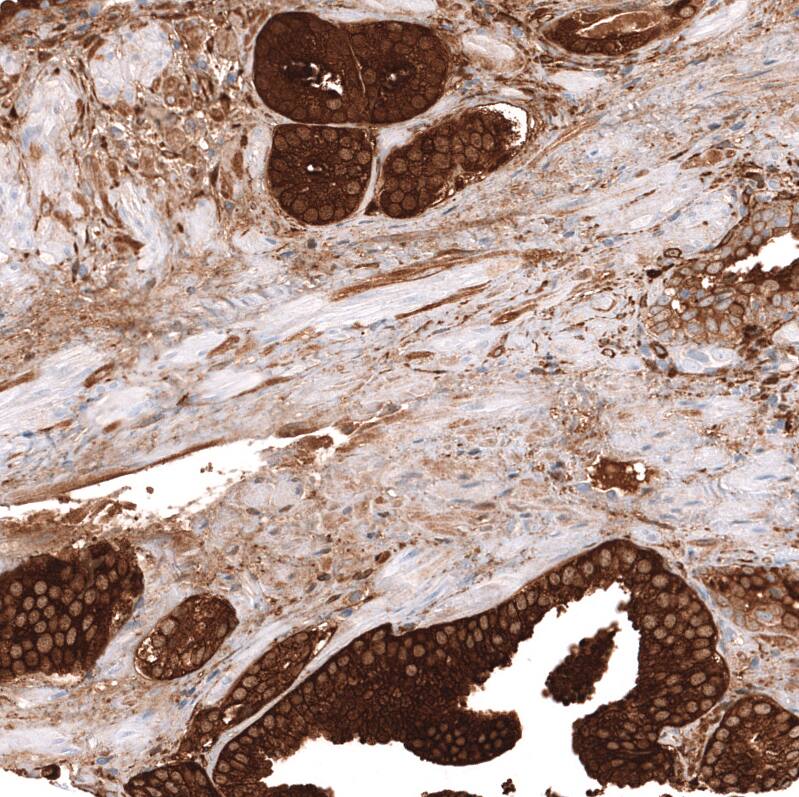 Staining of human prostate cancer shows strong cytoplasmic positivity in tumor cells.