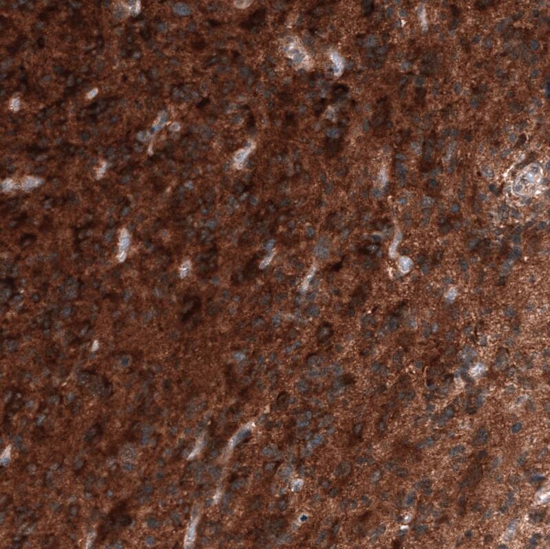 Staining of human glioblastoma multiforme shows strong positivity in tumor cells.