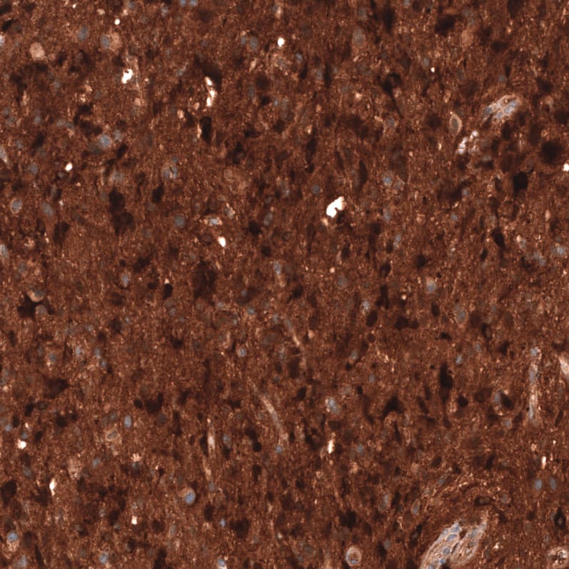 Staining of human astrocytoma shows strong cytoplasmic positivity in tumor cells.