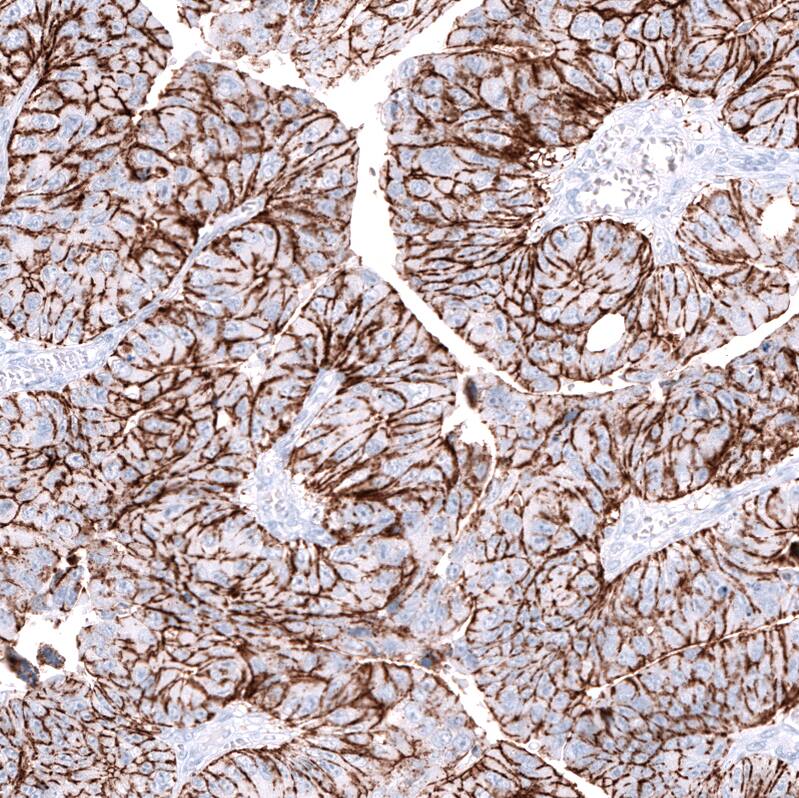 Staining of human colorectal cancer (metastasis to ovary) shows strong membranous positivity in tumor cells.