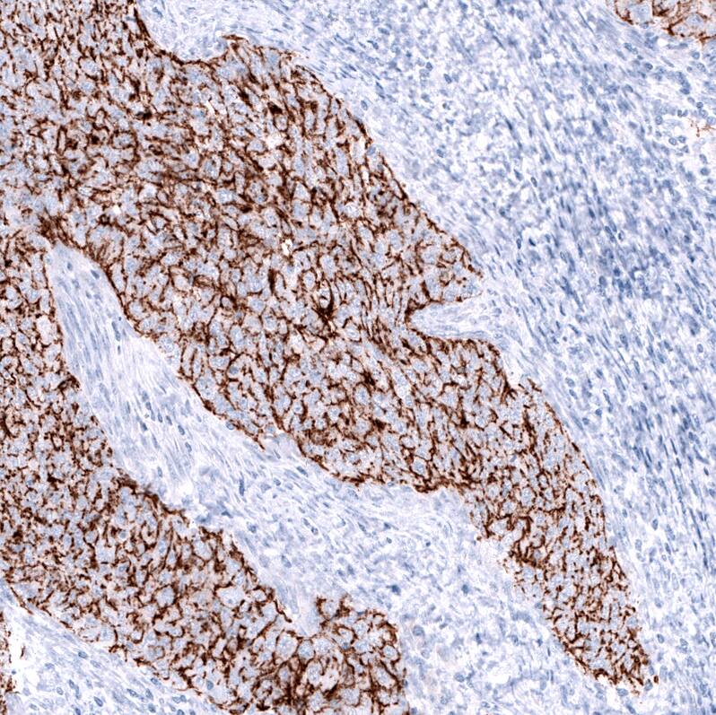 Staining of human endometrial cancer shows strong membranous positivity in tumor cells.