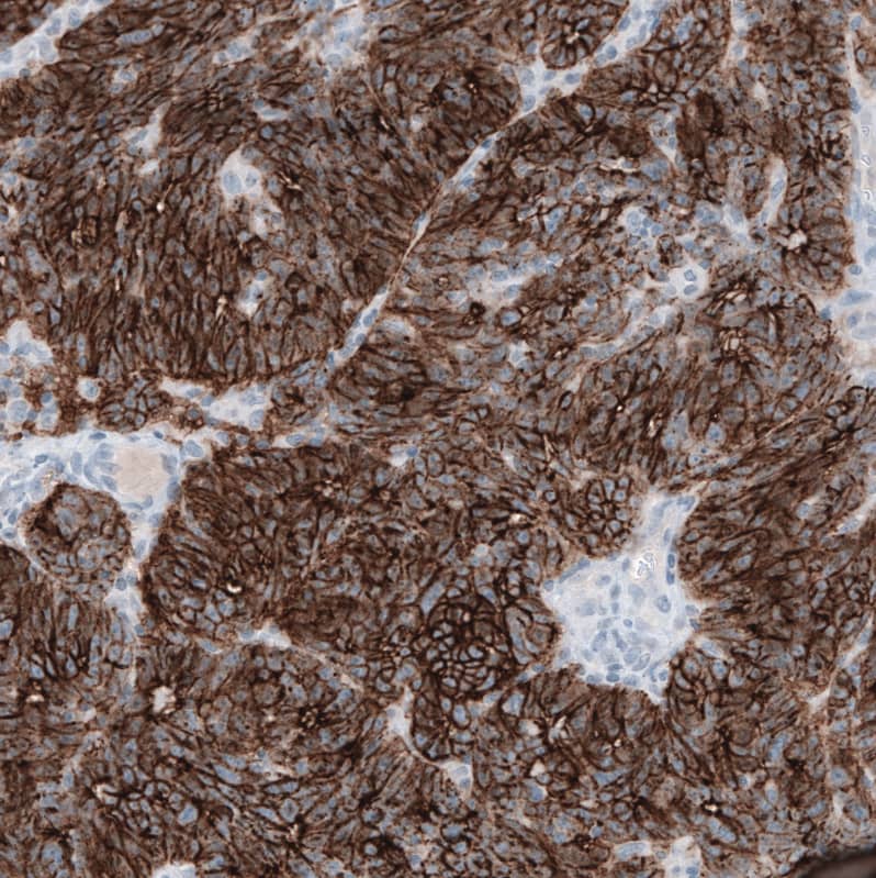 Staining of human ovarian cancer (endometrioid carcinoma) shows strong membranous positivity in tumor cells.