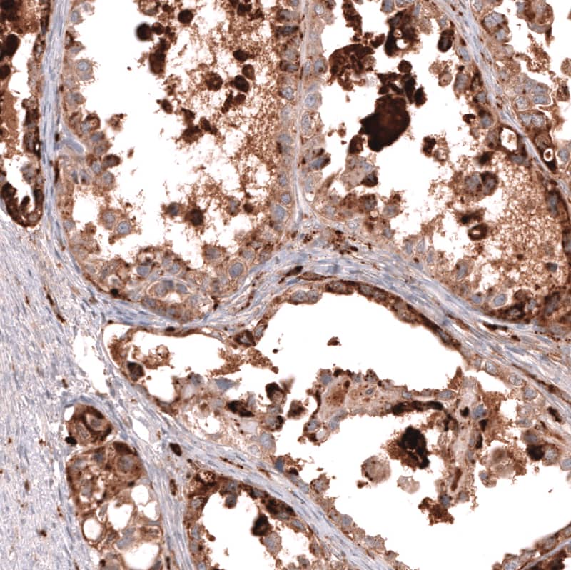 Staining of human ovarian cancer (clear cell carcinoma) shows moderate to strong granular cytoplasmic positivity in tumor cells.