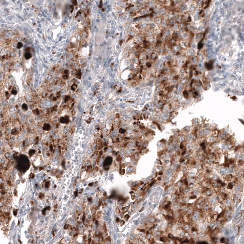 Staining of human lung cancer (adenocarcinoma) shows moderate to strong positivity in tumor cells.