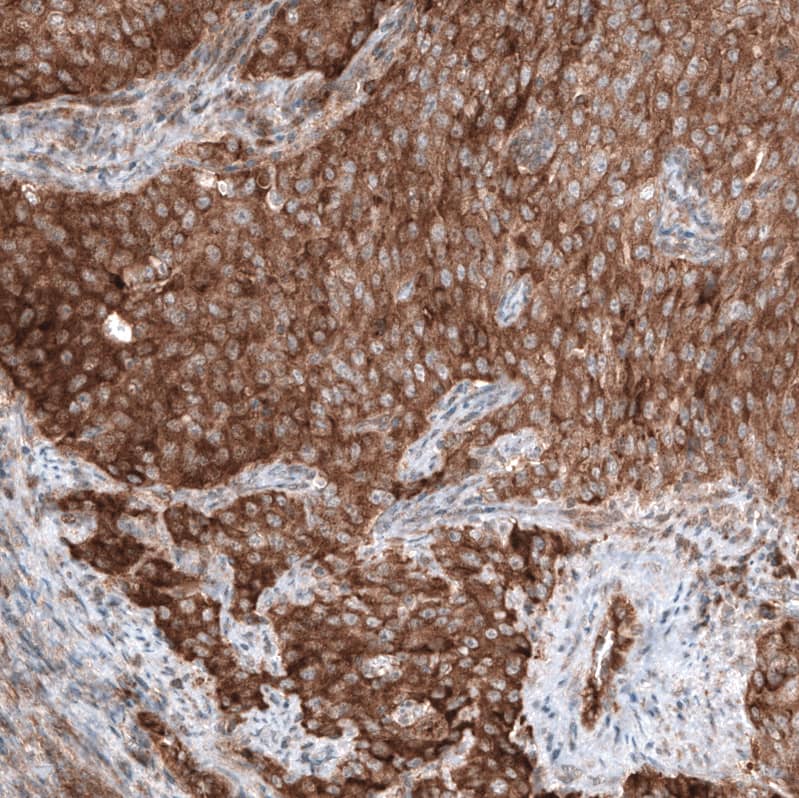 Staining of human cervical cancer shows strong cytoplasmic positivity in tumor cells.