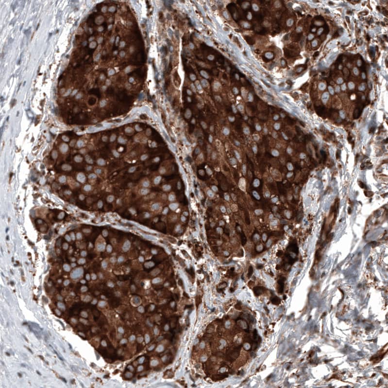 Staining of human breast cancer shows strong cytoplasmic positivity in tumor cells.