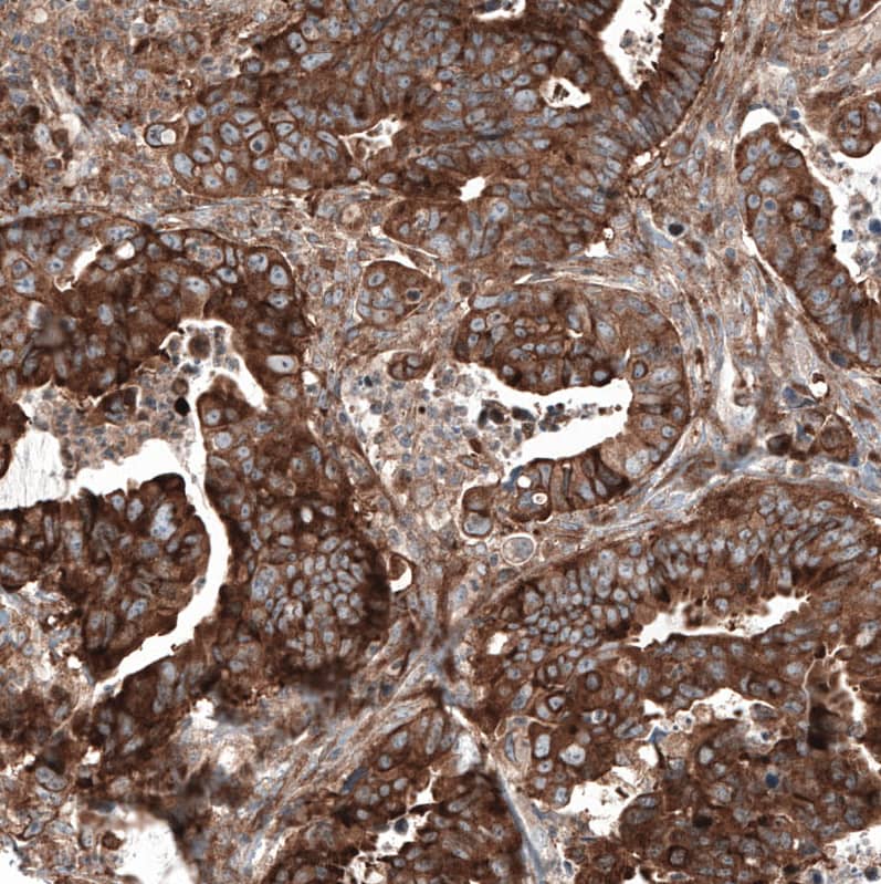 Staining of human colorectal cancer shows strong cytoplasmic positivity in tumor cells.