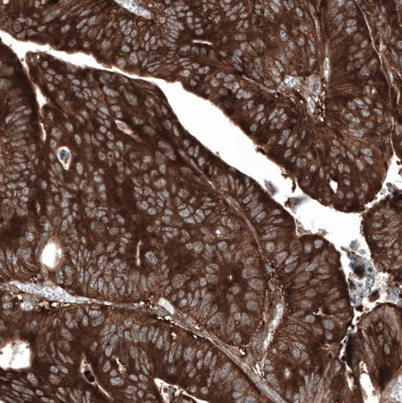 Staining of human colorectal cancer (metastasis to ovary) shows strong cytoplasmic positivity in tumor cells.
