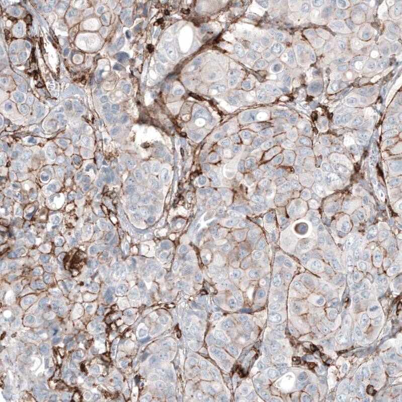 Staining of human breast cancer (metastasis to ovary) shows moderate membranous positivity in tumor cells.