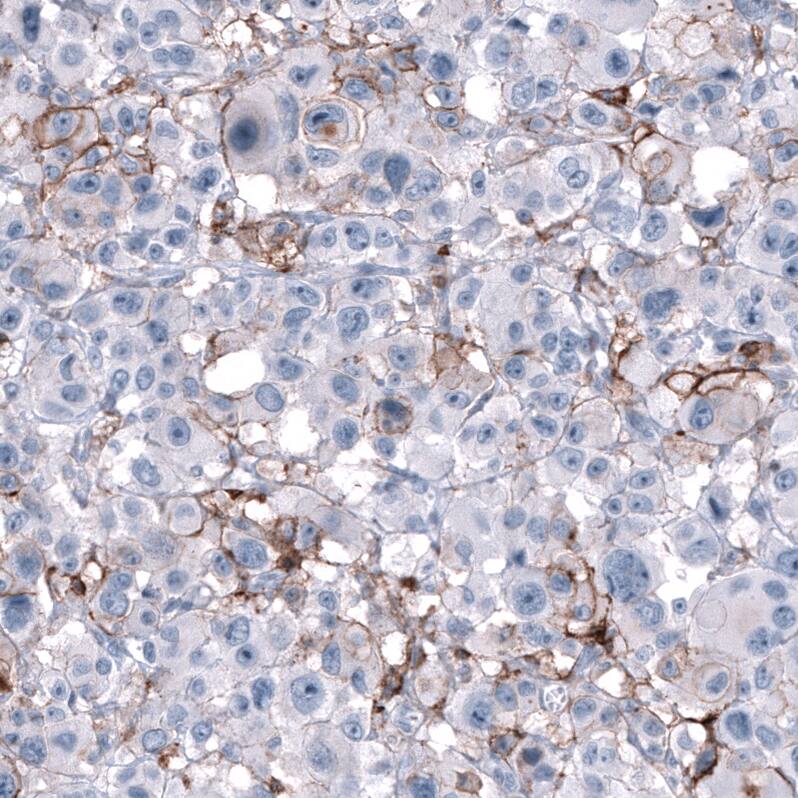Staining of human malignant melanoma shows moderate membranous positivity in tumor cells.
