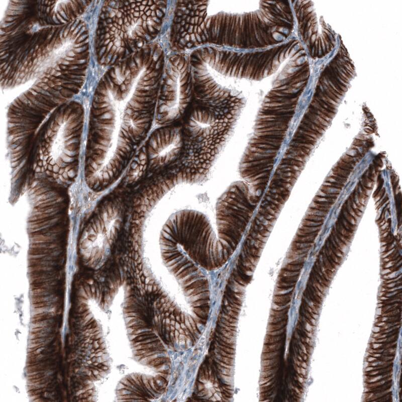 Staining of human ovarian cancer (low grade carcinoma) shows strong membranous positivity in tumor cells.