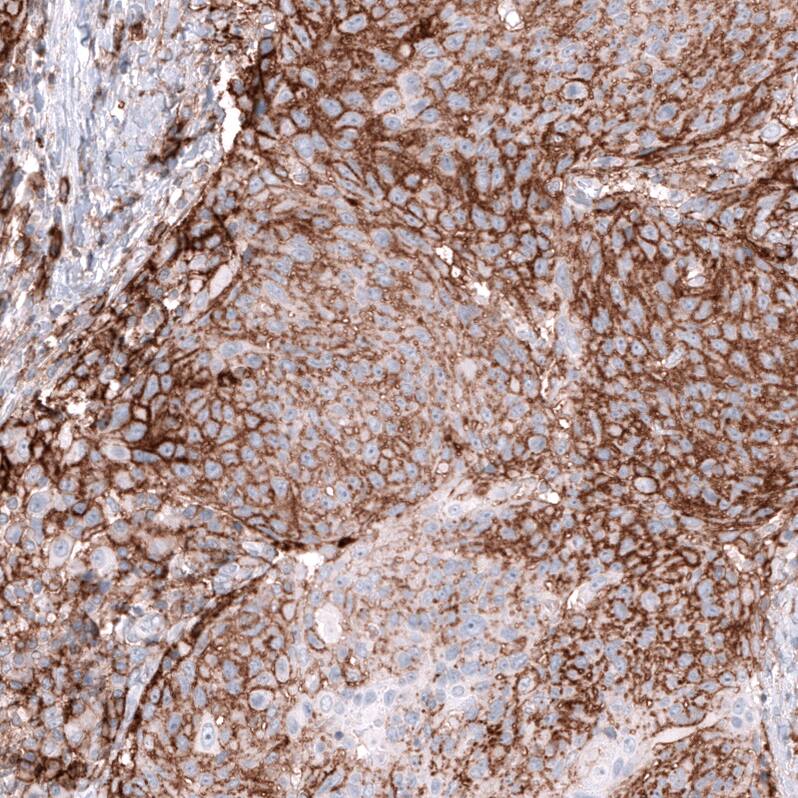 Staining of human cervical cancer shows strong membranous positivity in tumor cells.