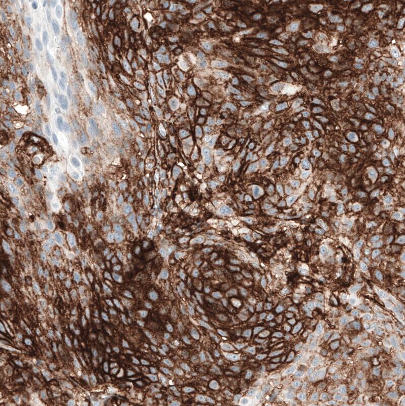 Staining of human cervical cancer shows strong membranous positivity in tumor cells.
