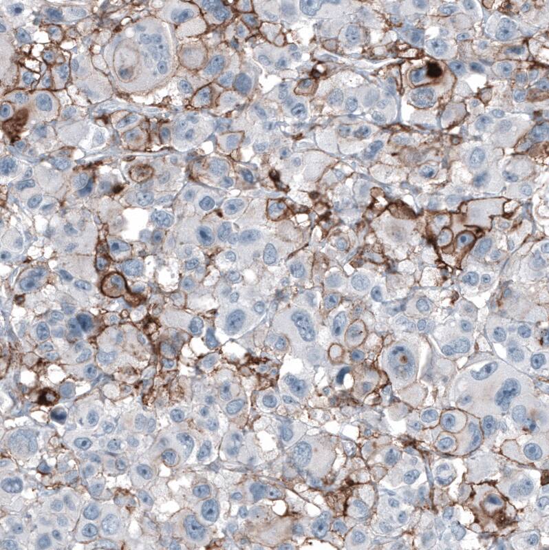 Staining of human malignant melanoma shows moderate membranous positivity in tumor cells.