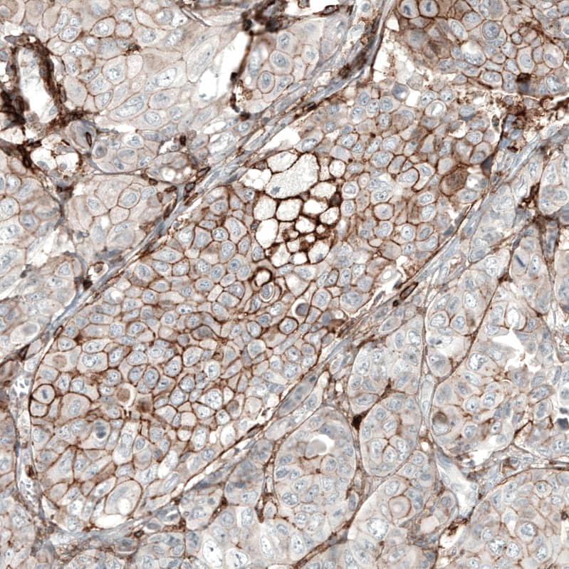 Staining of human breast cancer (metastasis to ovary) shows moderate membranous positivity in tumor cells.