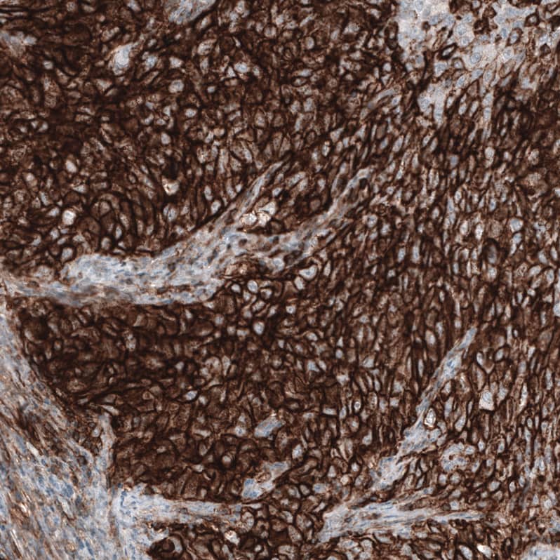 Staining of human endometrial cancer shows strong membranous positivity in tumor cells.