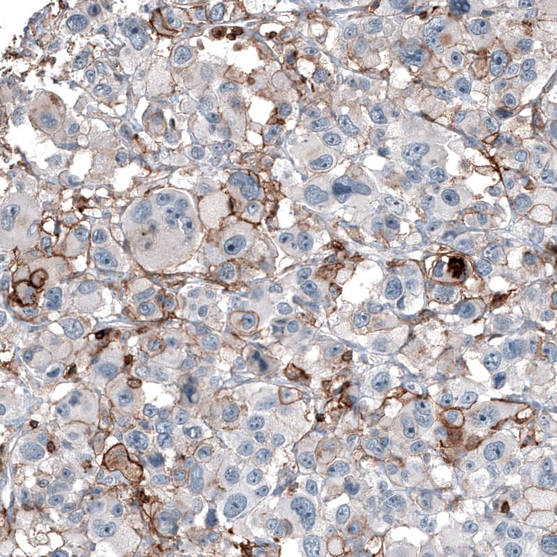 Staining of human malignant melanoma shows moderate membranous positivity in tumor cells.