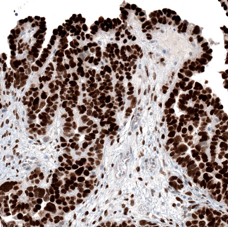 Staining of human ovarian cancer (papillary carcinoma) shows strong nuclear positivity in tumor cells.