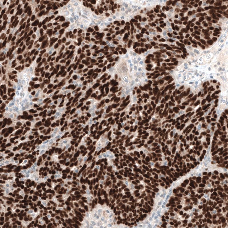 Staining of human ovarian cancer (endometrioid carcinoma) shows strong nuclear positivity in tumor cells.