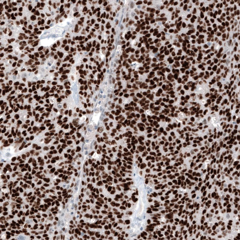 Staining of human ovarian cancer (high grade serous carcinoma) shows strong nuclear positivity in tumor cells.
