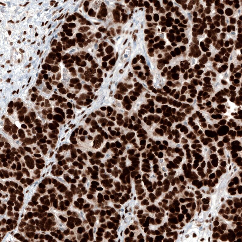 Staining of human ovarian cancer (papillary carcinoma) shows strong nuclear positivity in tumor cells.