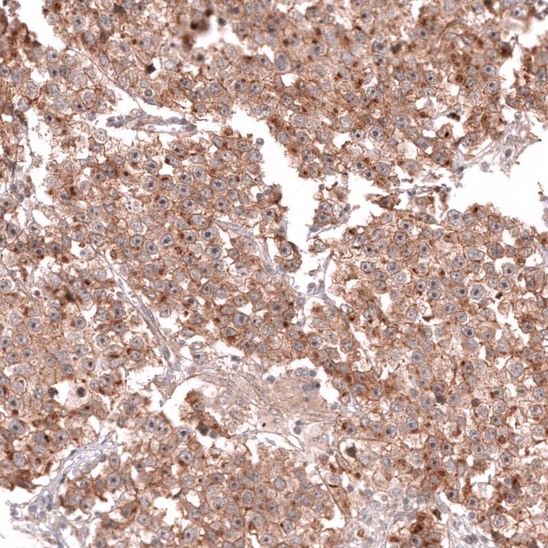 Staining of human ovarian cancer (dysgerminoma) shows moderate membranous positivity in tumor cells.