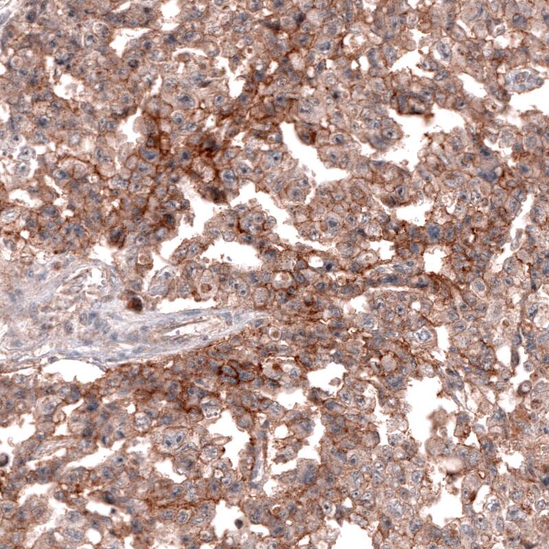 Staining of human testis cancer (embryonal carcinoma) shows moderate membranous positivity in tumor cells.