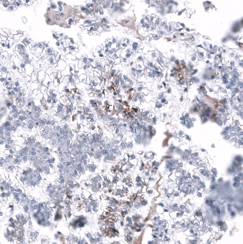 Staining of human ovarian cancer (clear cell carcinoma) shows moderate membranous positivity in a subset of tumor cells.